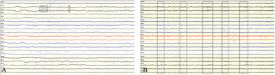 Case report: Varicella-zoster virus infection triggering progressive encephalomyelitis with rigidity and myoclonus